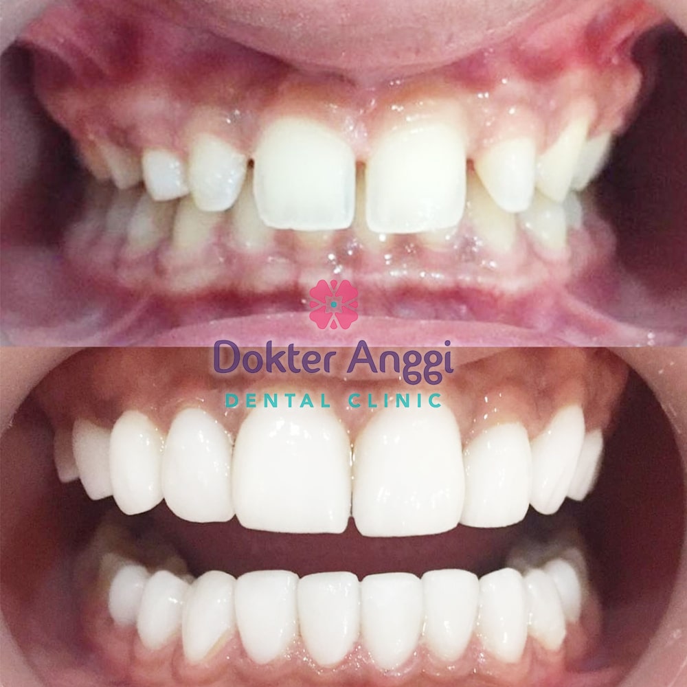 dokteranggi-bekasi-before-after-11