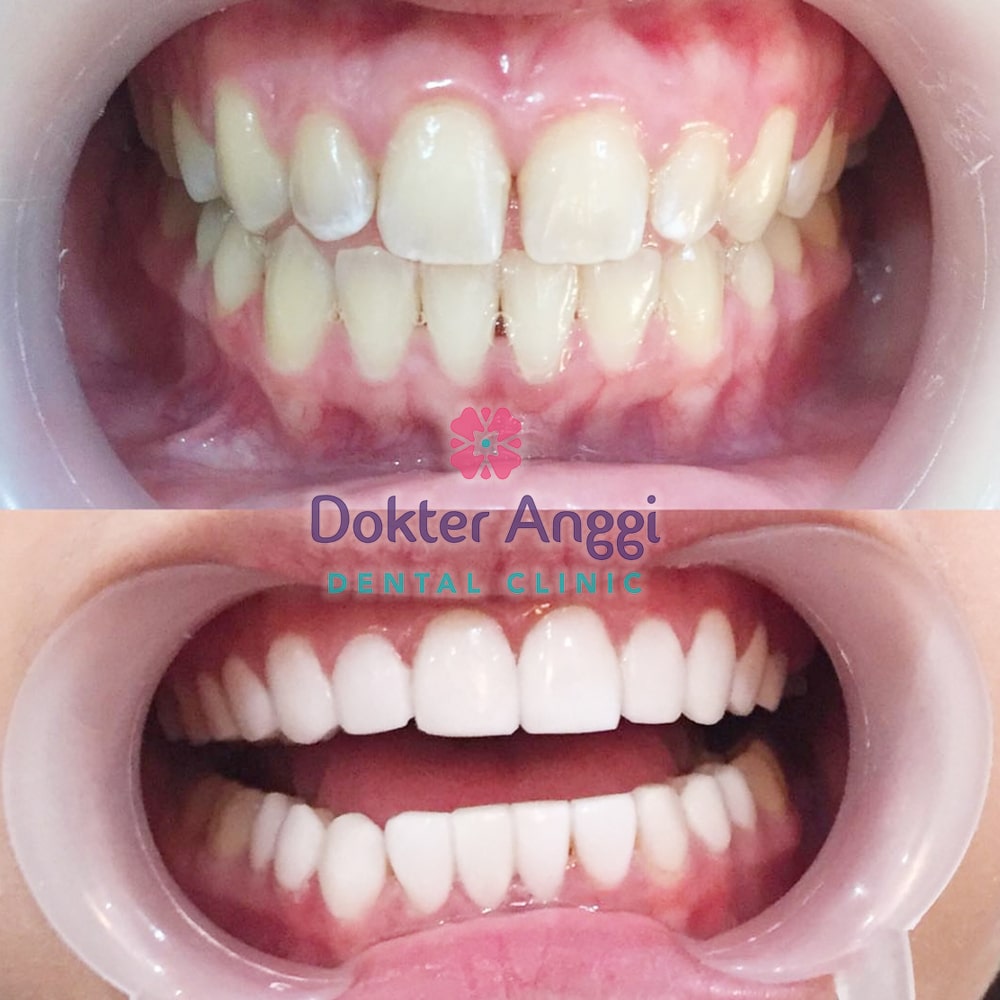 dokteranggi-bekasi-before-after-15