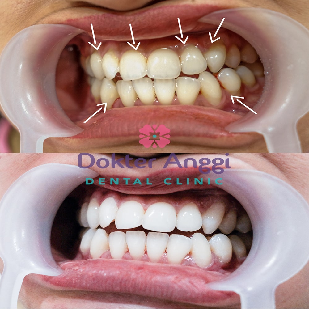 dokteranggi-bekasi-before-after-2