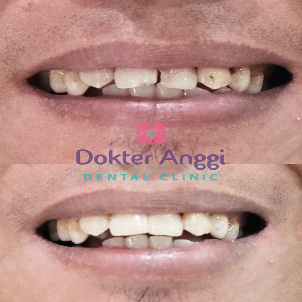 dokteranggi-bekasi-before-after-3