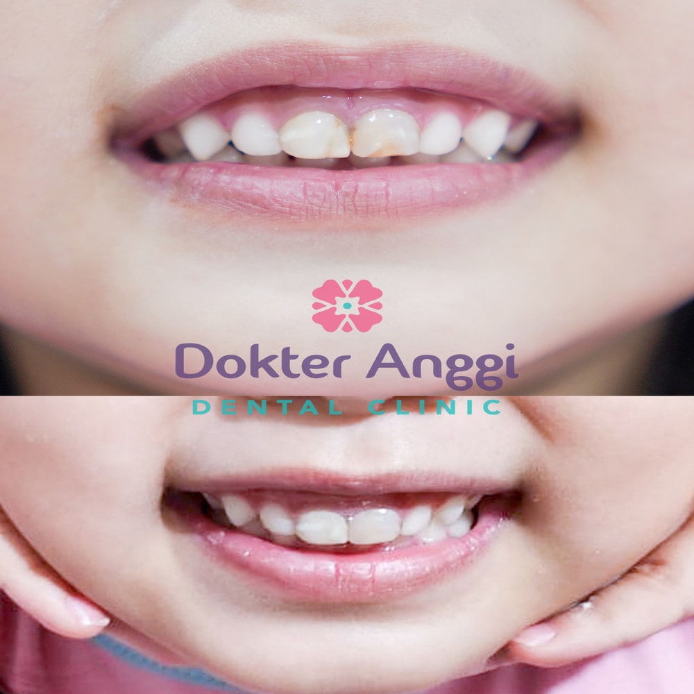 dokteranggi-bekasi-before-after-4