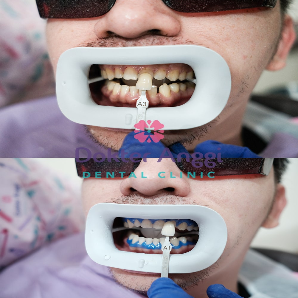 dokteranggi-bekasi-before-after-5