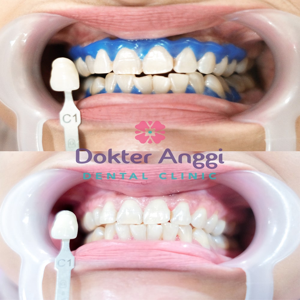 dokteranggi-bekasi-before-after-6