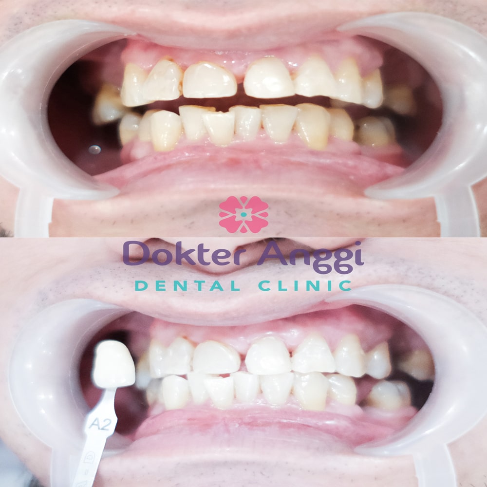 dokteranggi-bekasi-before-after-7