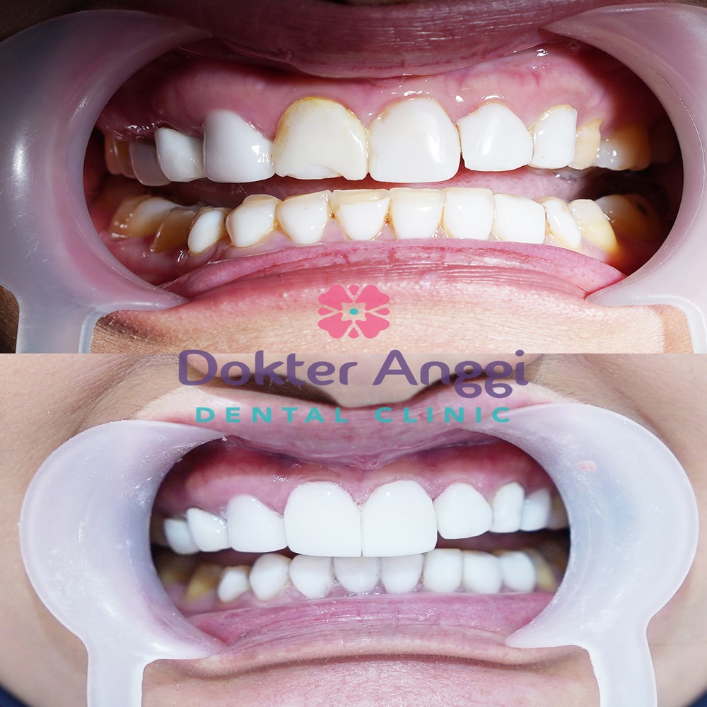 dokteranggi-bekasi-before-after-8